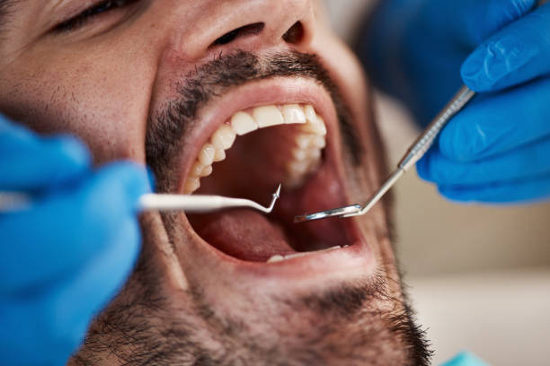 Best Emergency Dentist for Lost Fillings or Crowns in Sylvania, OH