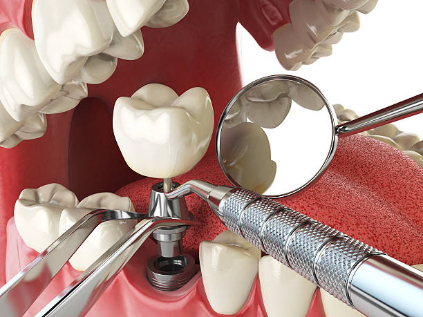 Best Emergency Dental Extractions in Sylvania, OH