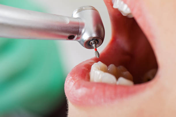 Best Emergency Root Canal Treatment in Sylvania, OH